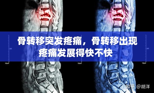 骨轉(zhuǎn)移突發(fā)疼痛，骨轉(zhuǎn)移出現(xiàn)疼痛發(fā)展得快不快 