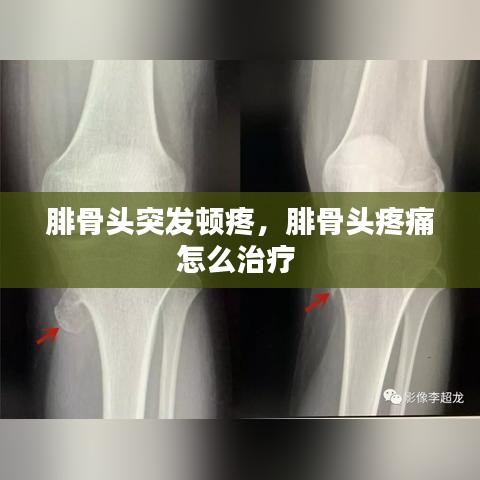 腓骨頭突發(fā)頓疼，腓骨頭疼痛怎么治療 