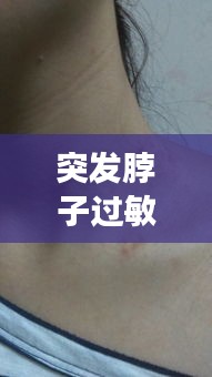 突發(fā)脖子過(guò)敏，脖子突然過(guò)敏是怎么回事 